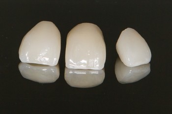 Couronne dentaire, pivot, couronne sur implant, qu'est-ce que c'est?